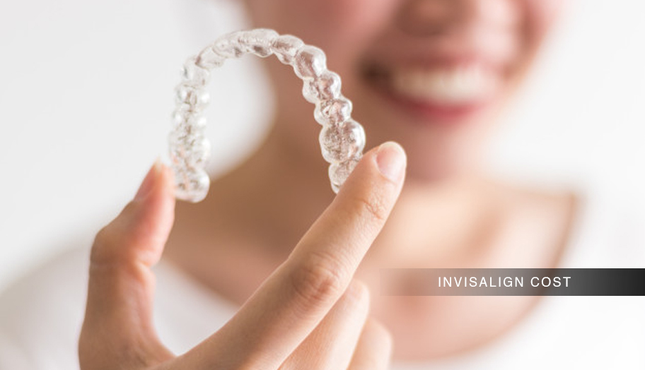 How Much Does Invisalign Cost? Myce.wiki